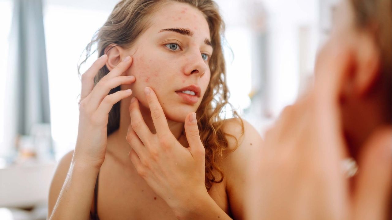 L'acné hormonale